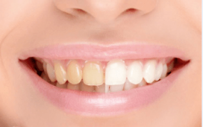 Dişlerinizi 2 Dakikada Beyazlatacak Doğal Yöntemler
