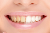 Dişlerinizi 2 Dakikada Beyazlatacak Doğal Yöntemler