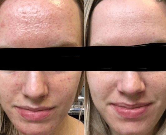 does nizoral shampoo work for fungal acne